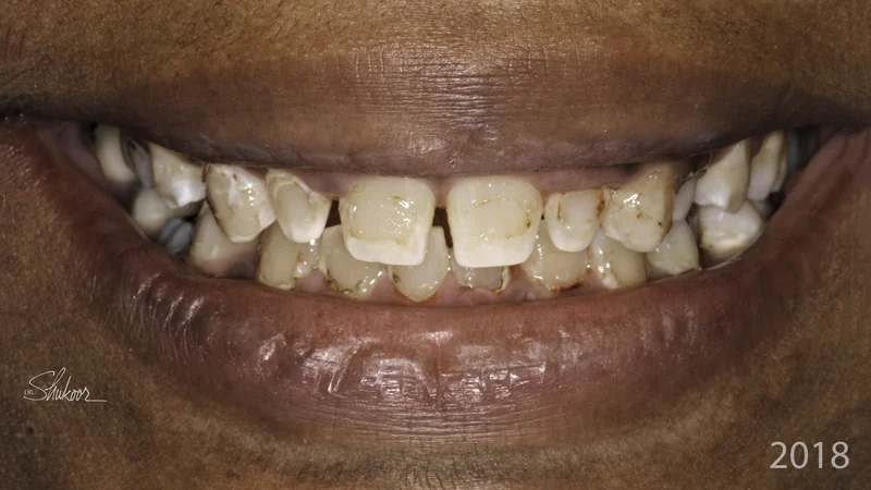 Complete smile makeover for a brighter, balanced smile, close-up view: before treatment