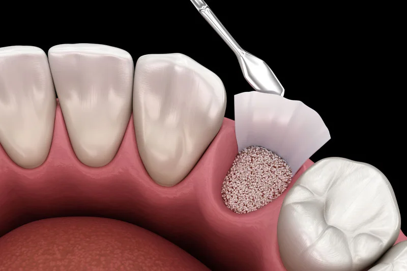 Illustration of socket preservation with graft particles and a membrane