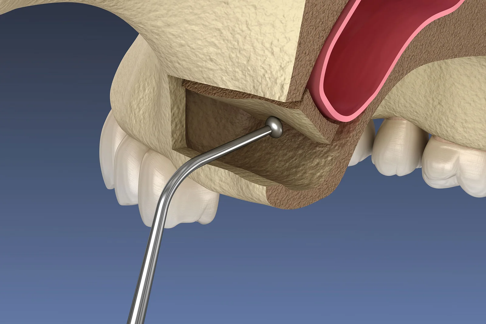 Cross-section illustration of posterior maxilla and sinus floor elevation