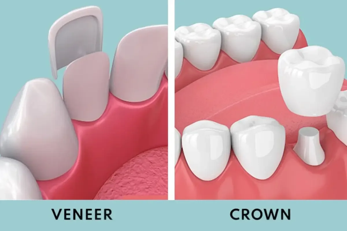 Side-by-side illustration comparing a porcelain veneer and a full crown