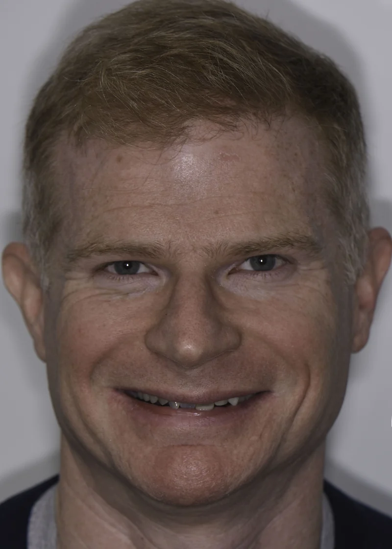 Damaged and discolored teeth renewed with full-mouth rehabilitation, smile view: before treatment