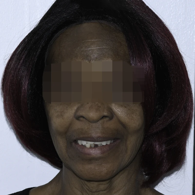 Failing upper teeth replaced with a fixed implant-supported arch, full face view: before treatment
