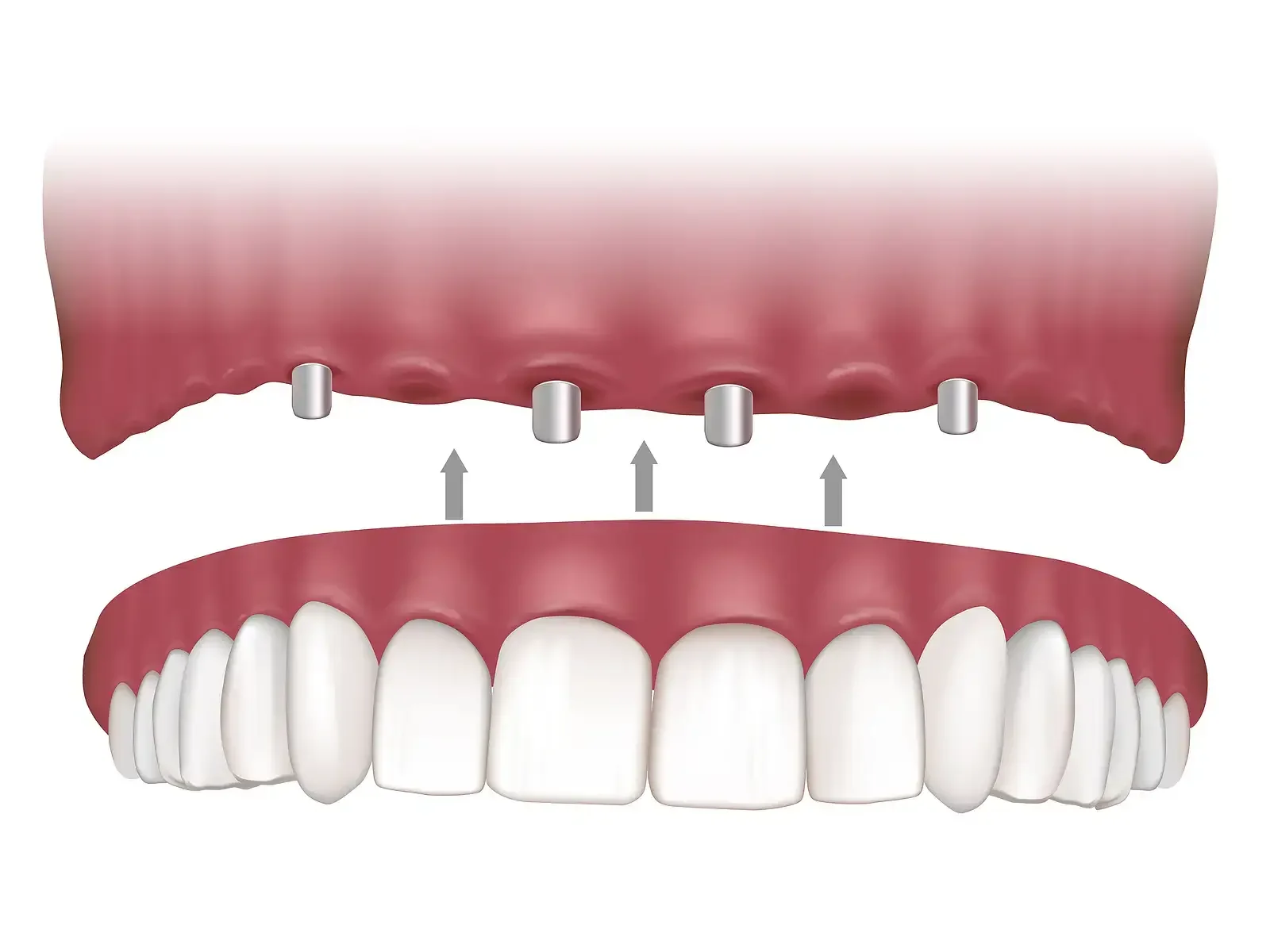 Illustration of a fixed hybrid full-arch restoration seating onto implants