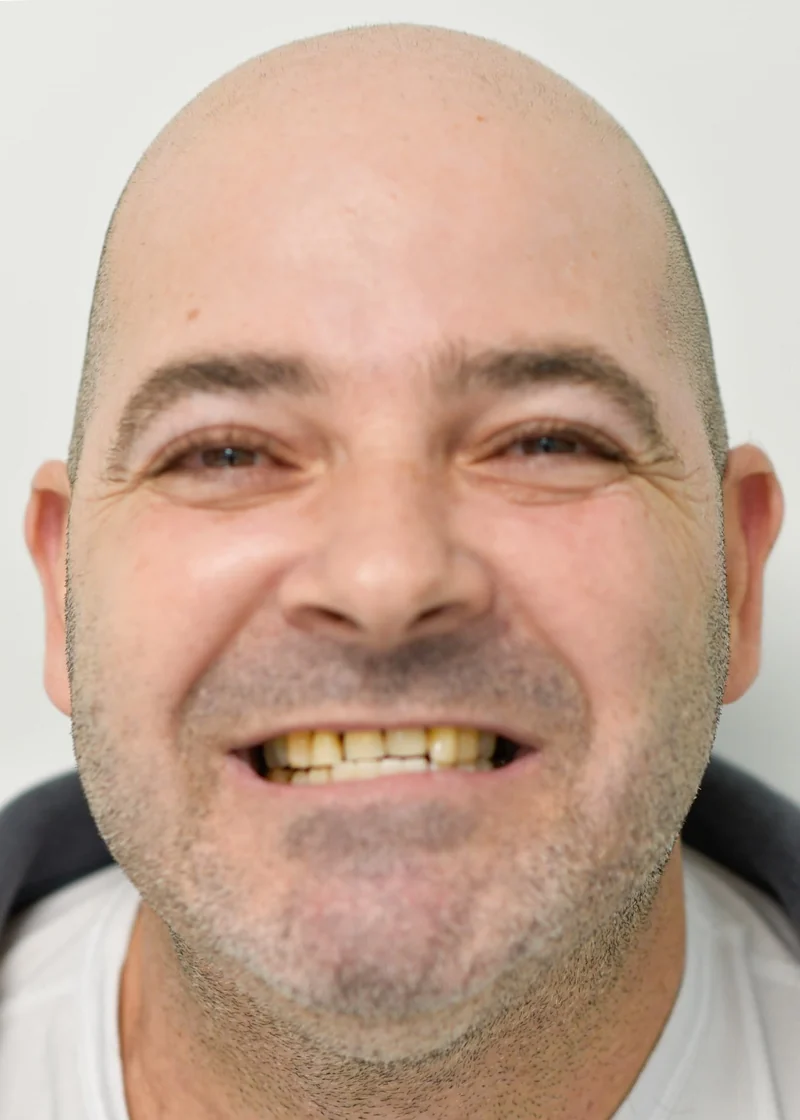 Worn, discolored dentition restored with full-arch implants, smile view: before treatment