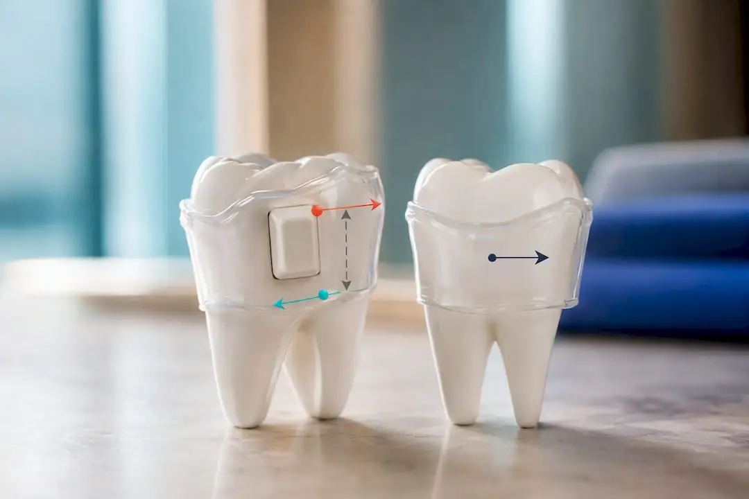 Illustration of aligner attachment force couple