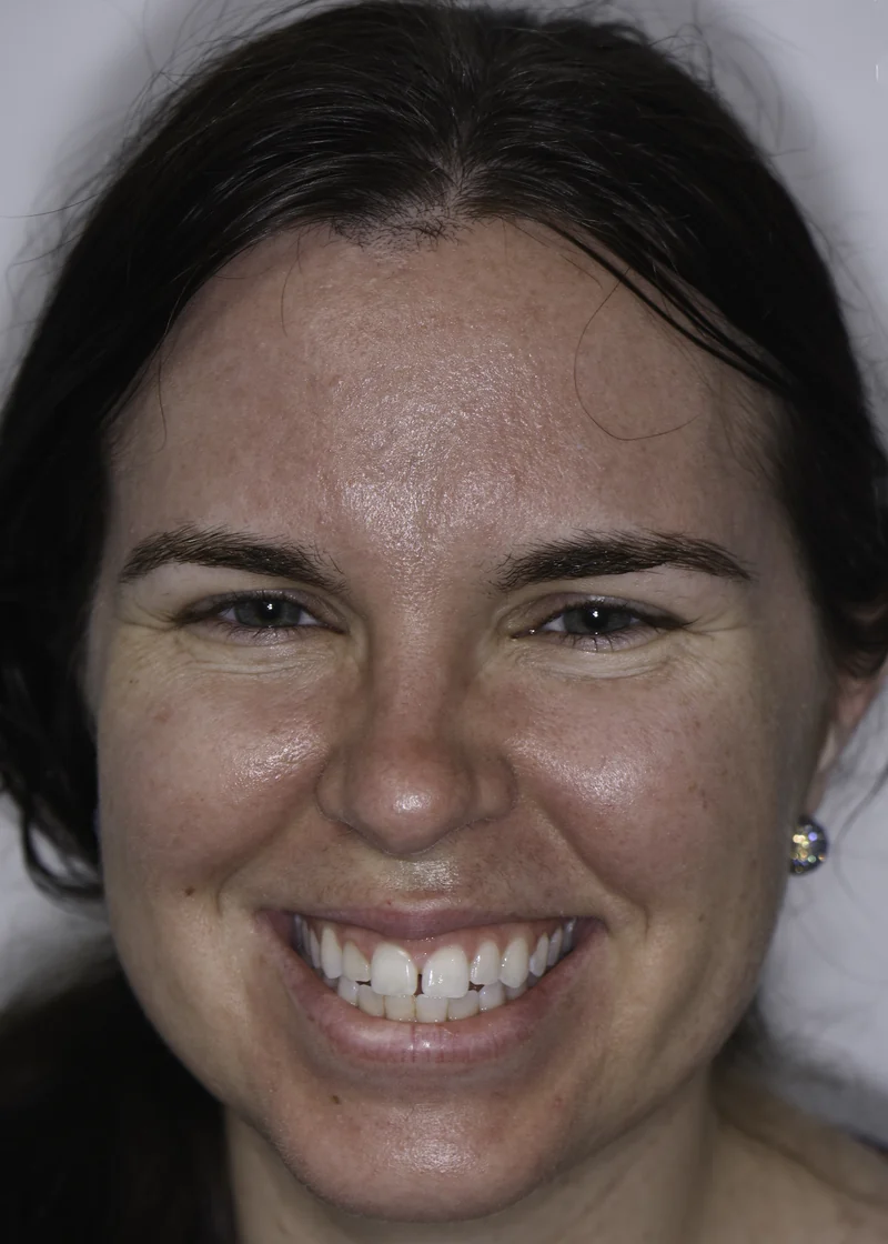 Uneven spacing and rotation corrected with clear aligners, full smile view: before treatment