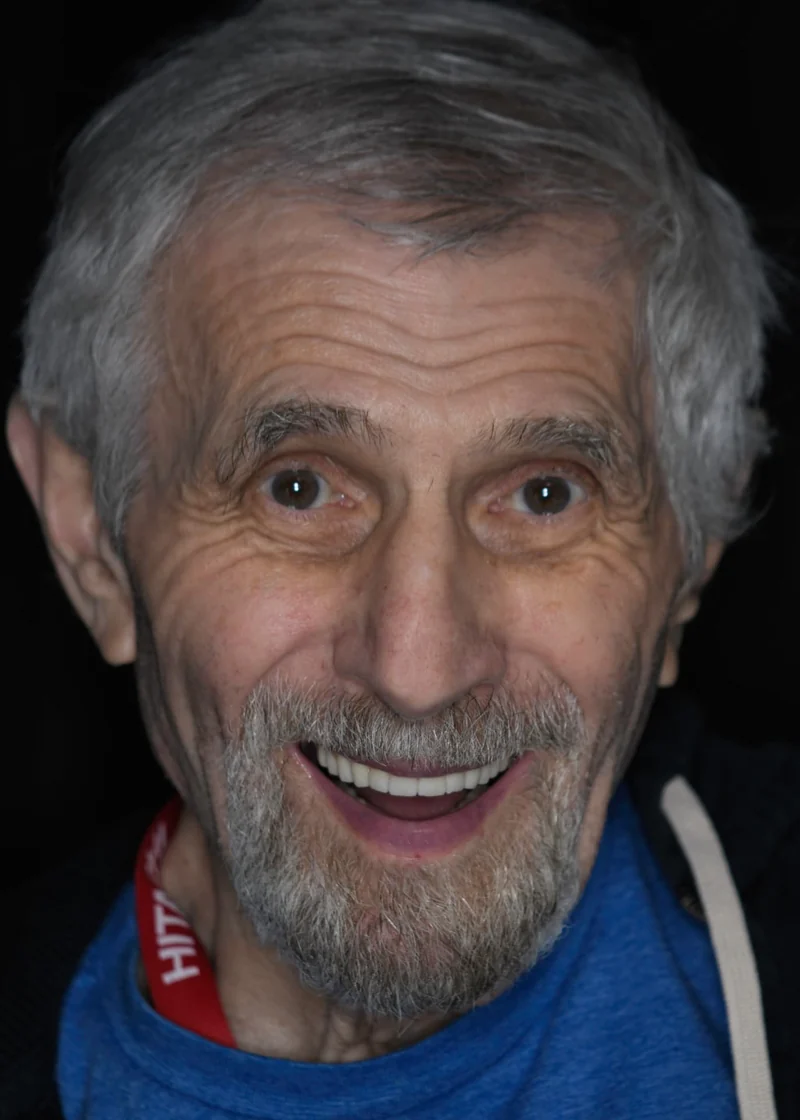 Complete upper and lower reconstruction on dental implants, portrait view: after treatment