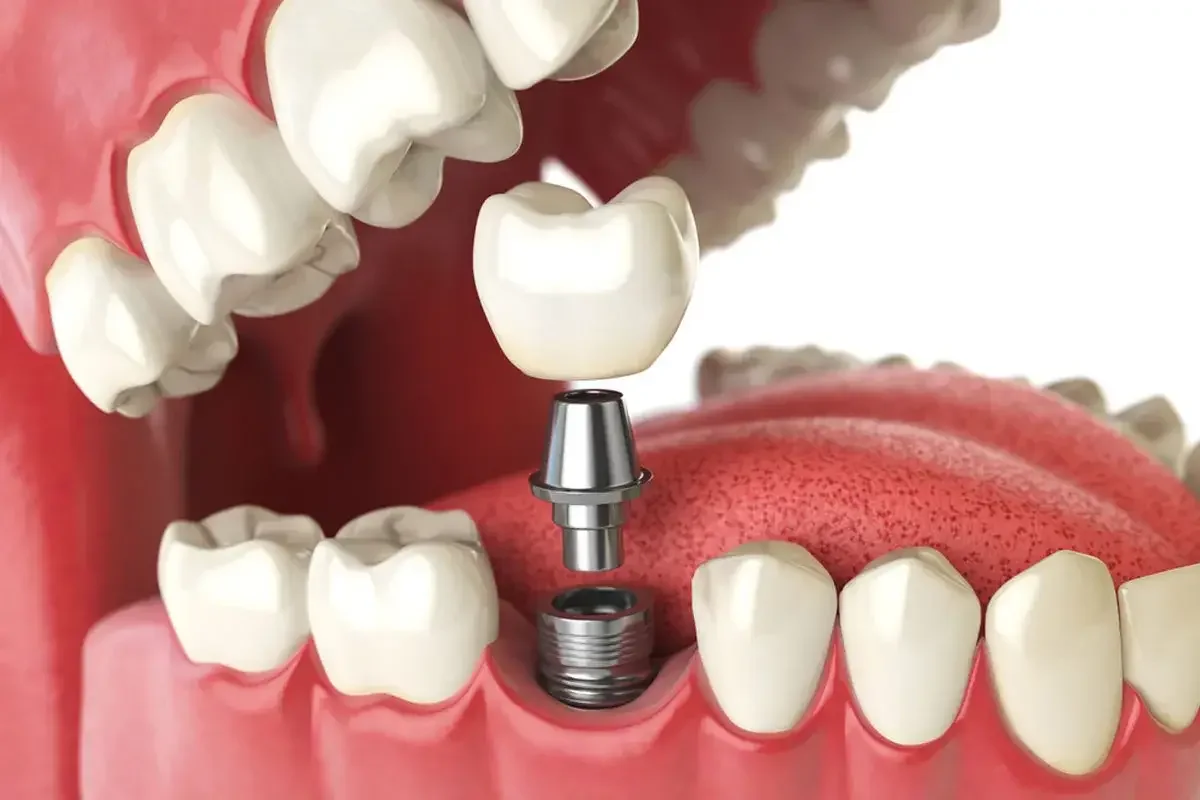 Illustration of an implant abutment and crown being seated in the lower arch
