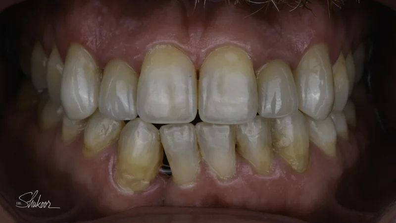 Smile makeover restores symmetry and a healthy shade, full smile view: after treatment