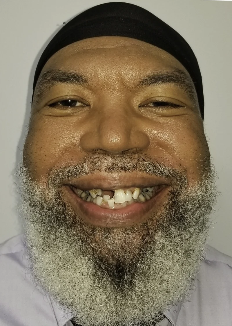 Broken-down teeth rebuilt with full-arch implant restoration, smile view: before treatment