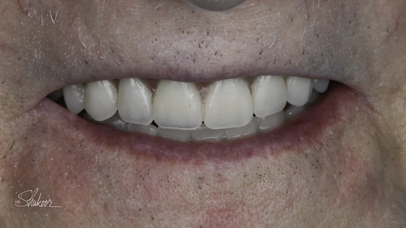 Full dentures restore a complete smile and comfortable bite, close-up view: after treatment