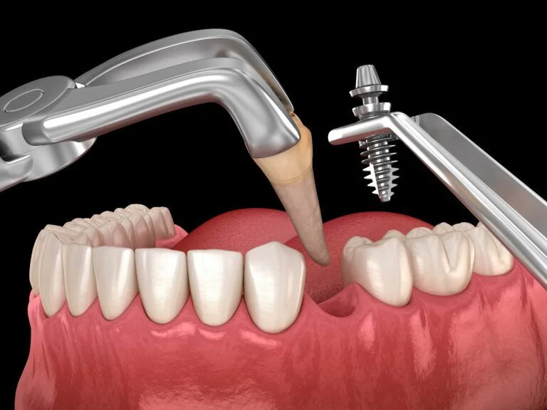 Illustration of tooth extraction beside an implant ready for immediate placement