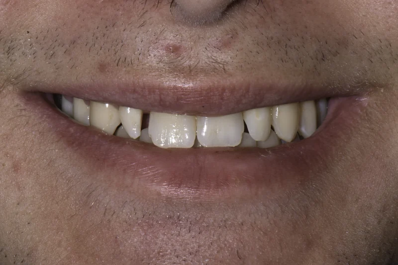 Small, uneven front teeth rebuilt with porcelain veneers, close-up view: before treatment