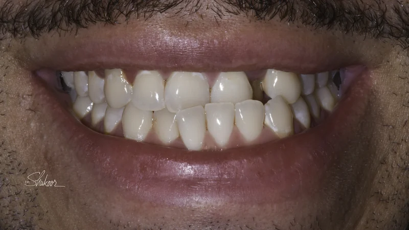 Crowded arch expanded and leveled with clear aligners, smile view: before treatment