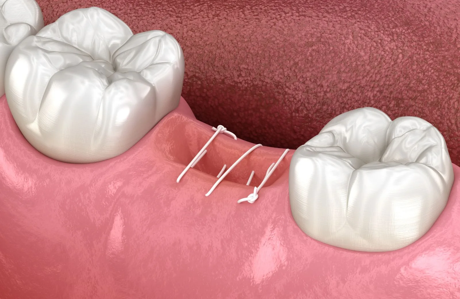 Illustration of simple interrupted sutures closing gingival tissue