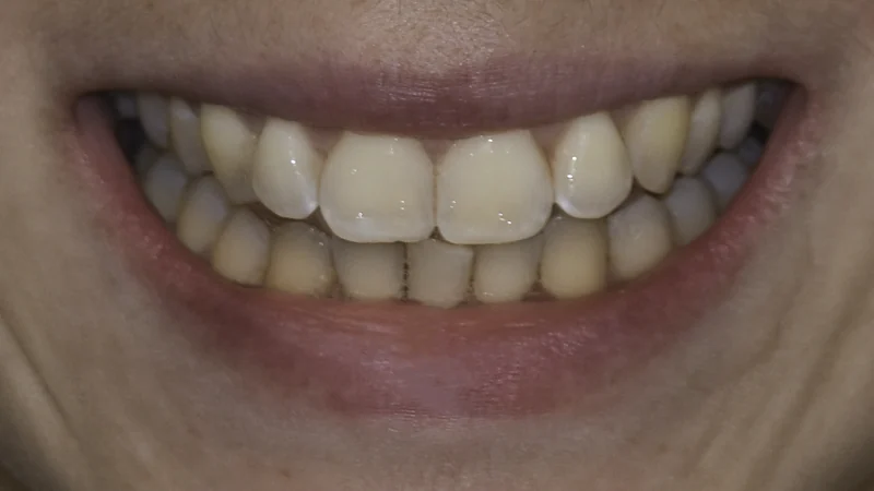 Overlapping front teeth straightened with clear aligner therapy, close-up view: before treatment