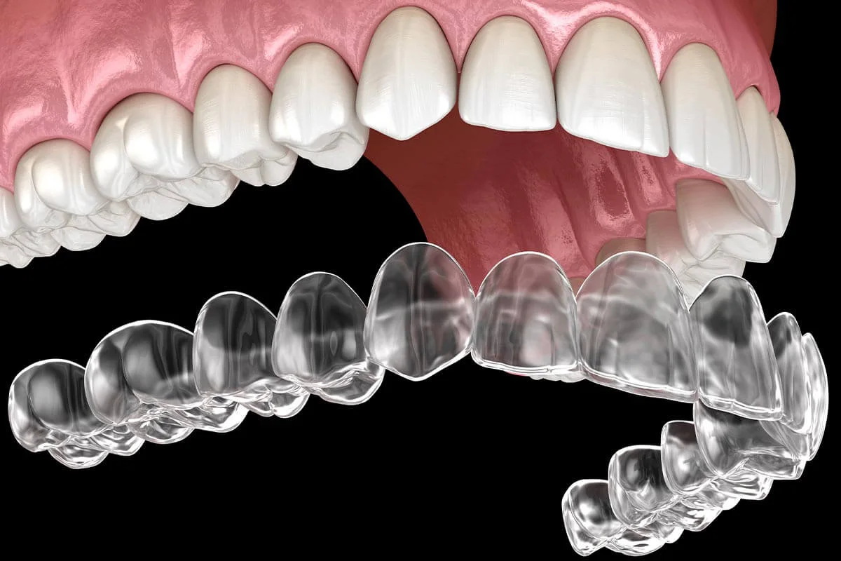 Clear aligner tray positioned below an upper dental arch