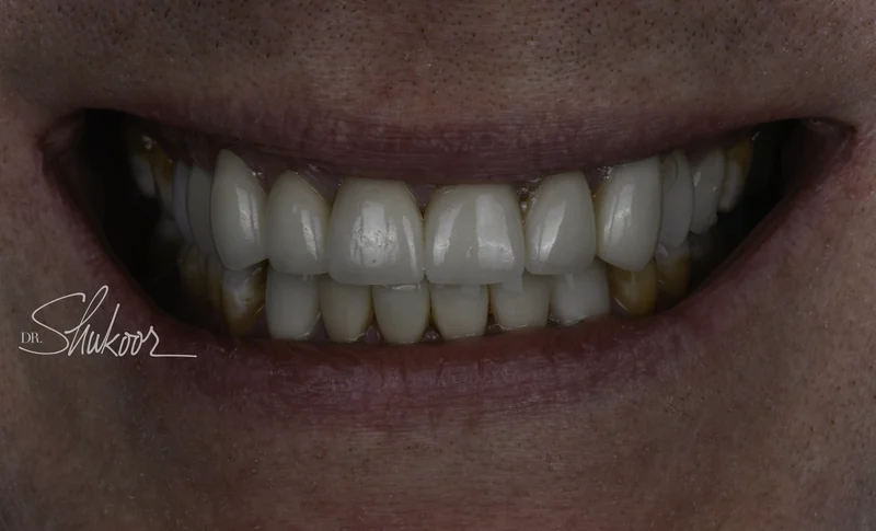 Smile makeover brightens and evens worn front teeth, close-up view: after treatment