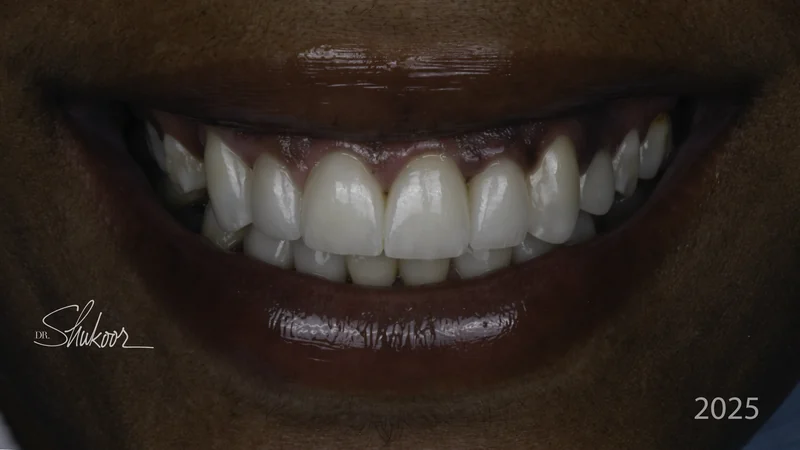 Complete smile makeover for a brighter, balanced smile, close-up view: after treatment