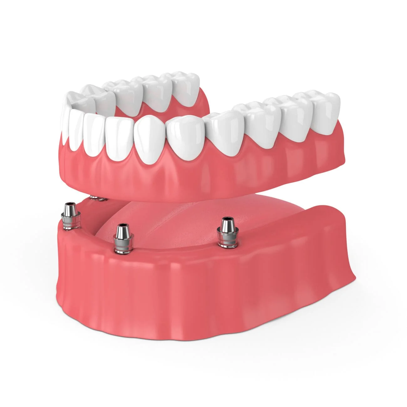 Implant-retained full-arch hybrid prosthesis above a mandibular model