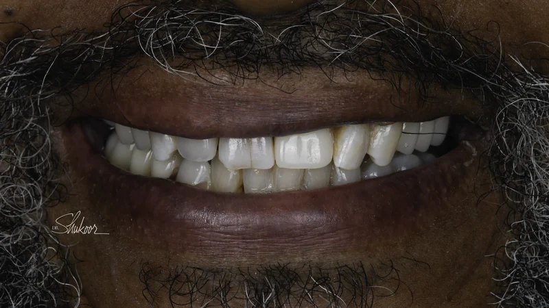 Missing front tooth replaced immediately with a dental flipper, close-up view: after treatment