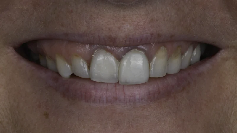 Dark, aging front crowns renewed with implant restorations, smile view: before treatment