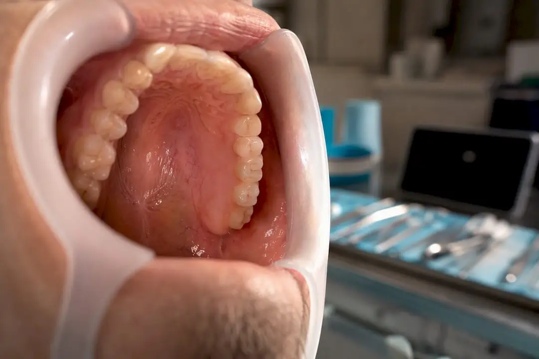 Close-up of palatal donor tissue area