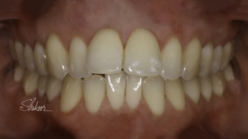 Worn, uneven incisal edges realigned with clear aligners, close-up view: before treatment