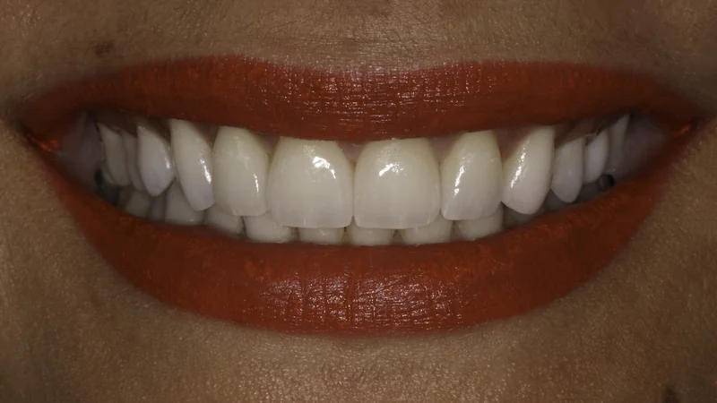 Gap Between Front Teeth Closed With Porcelain Veneers, close-up view: after treatment