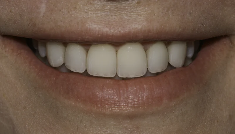 Chipped, worn, and discolored front teeth renewed with porcelain veneers, close-up view: after treatment