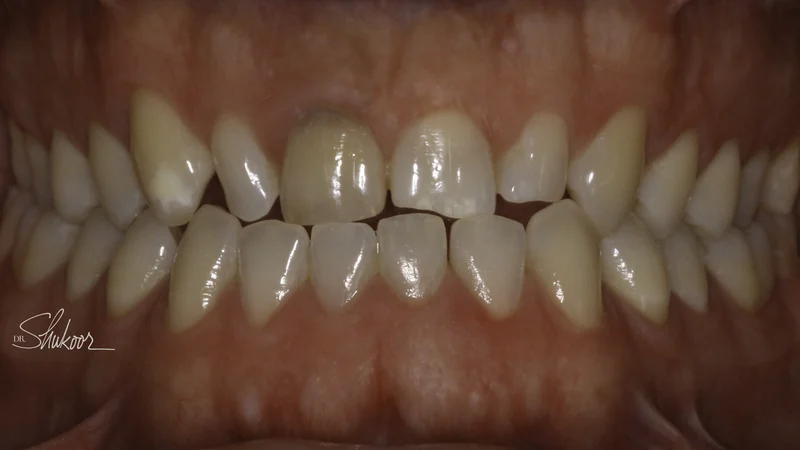 Smile makeover transforms shape, shade, and alignment, close-up view: before treatment