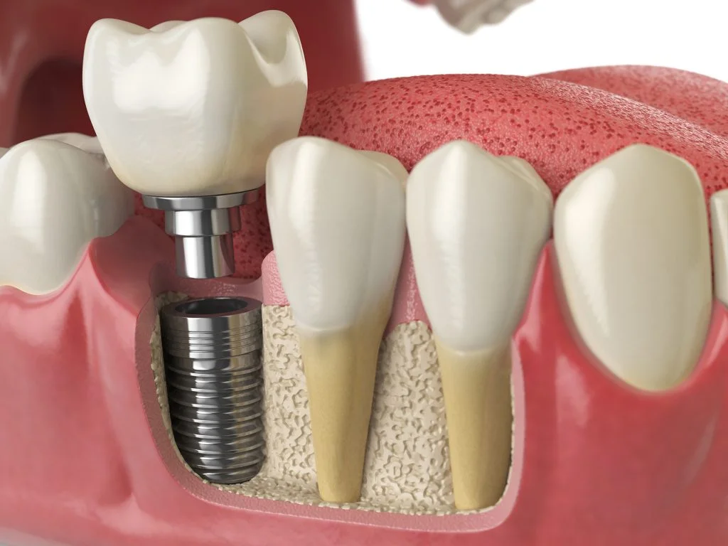 Cross-section illustration of an implant crown placed beside natural teeth
