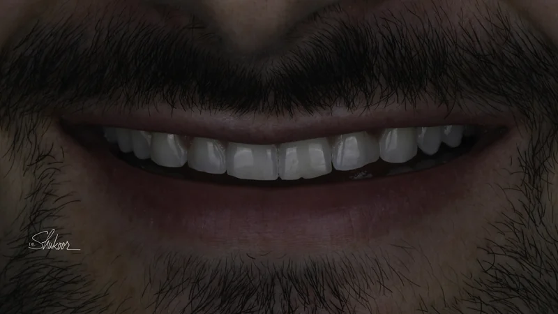 Worn & Uneven Front Teeth Rebuilt With Porcelain Veneers, full smile view: before treatment