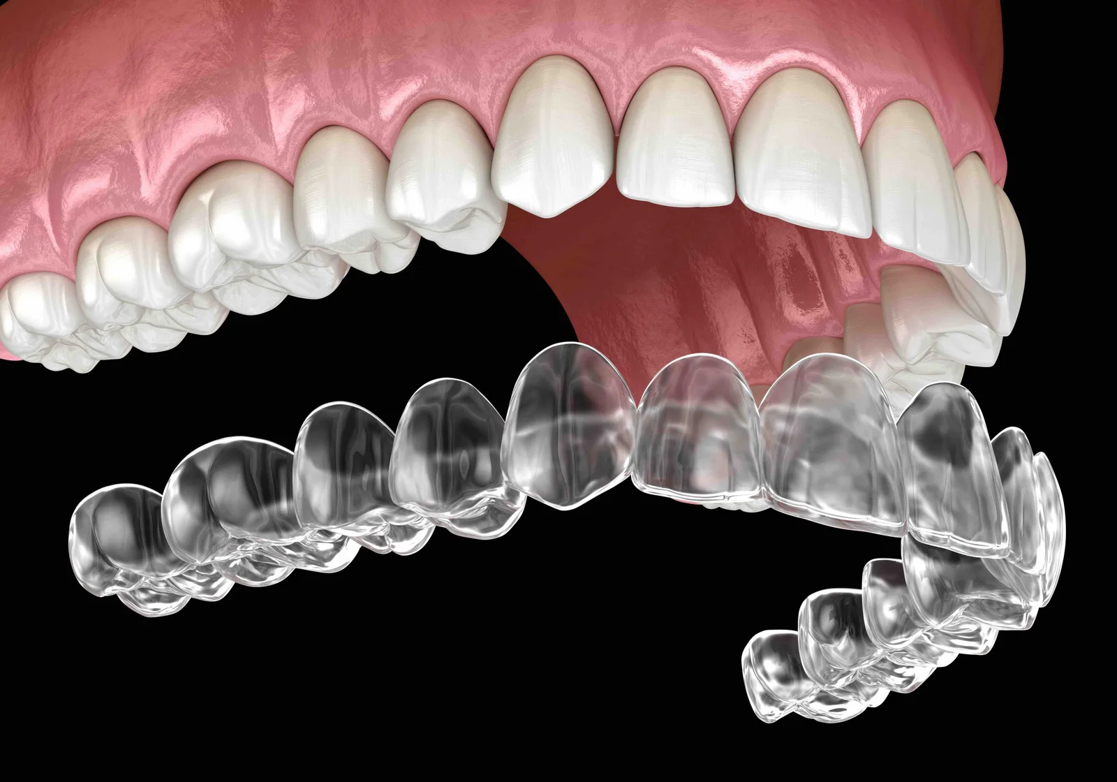 Clear aligner tray beside an upper dental arch on a dark background