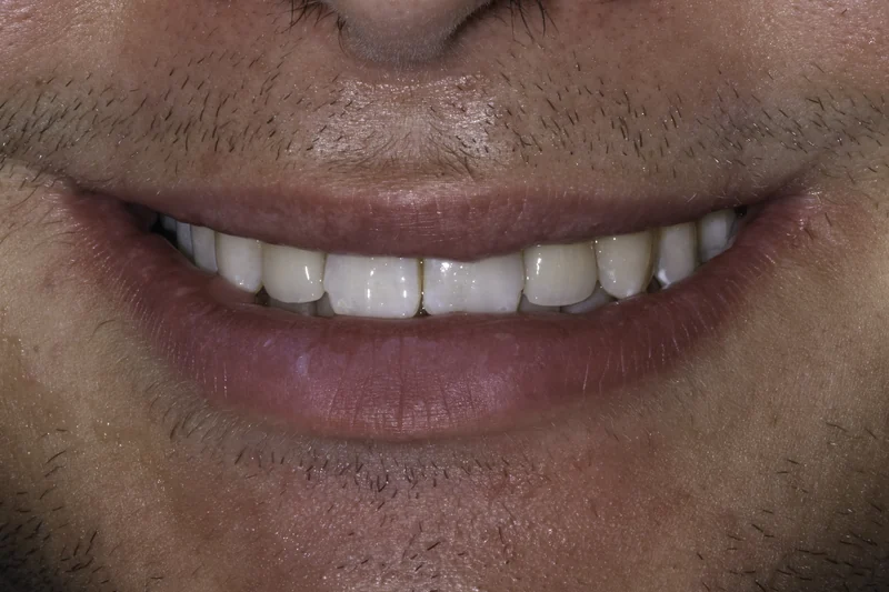 Small, uneven front teeth rebuilt with porcelain veneers, close-up view: after treatment