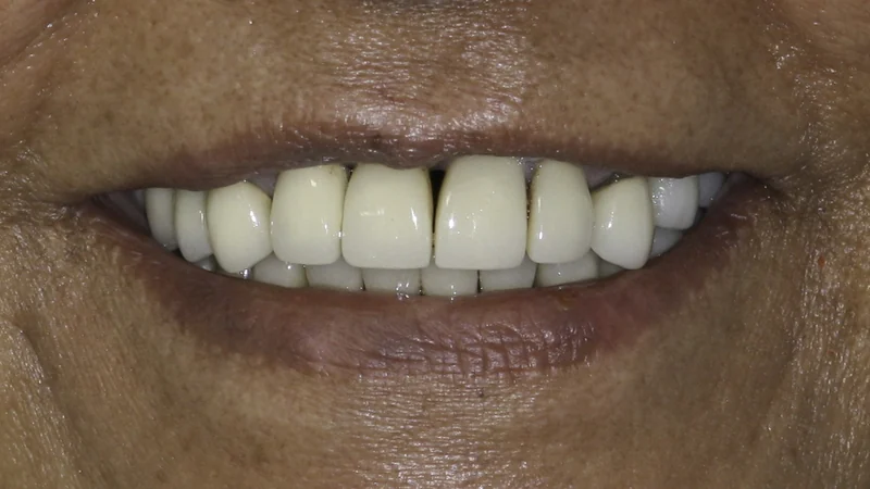 Worn, mismatched restorations rebuilt in a full-mouth rehabilitation, smile view: before treatment