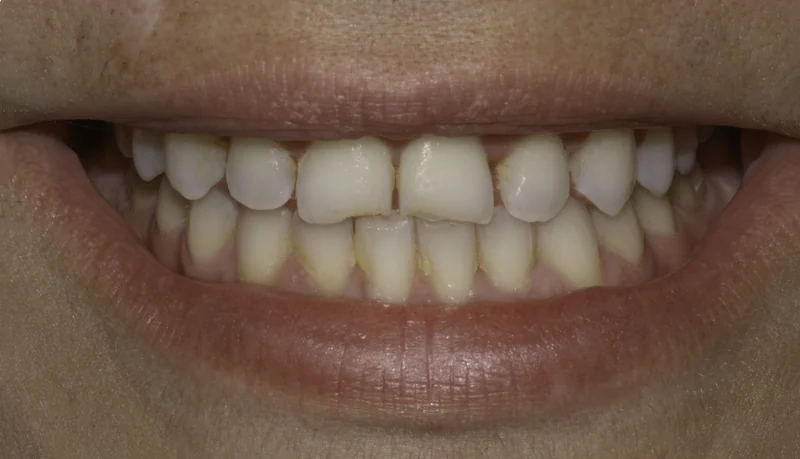 Chipped, worn, and discolored front teeth renewed with porcelain veneers, close-up view: before treatment