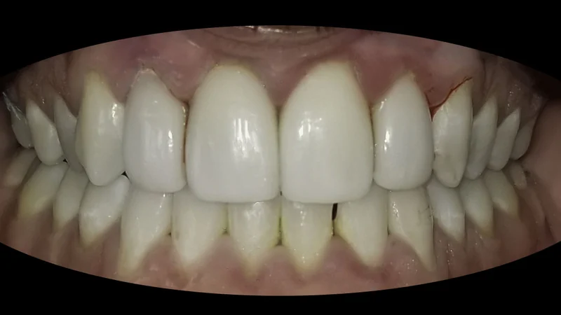 Mismatched Front Teeth Evened Out With Veneers, close-up view: before treatment
