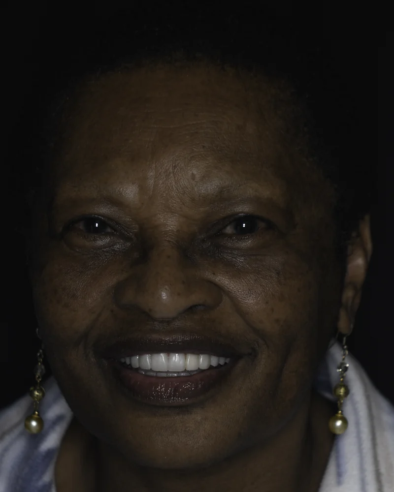 Failing dentition replaced with fixed full-arch implant teeth, full smile view: after treatment