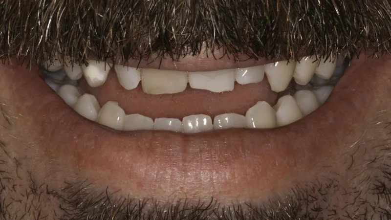 Worn, discolored smile rebuilt with a complete smile makeover, smile view: before treatment