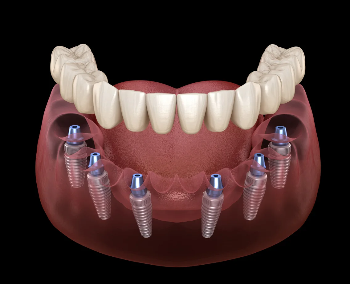 Illustration of a full-arch implant bridge on multiple implants