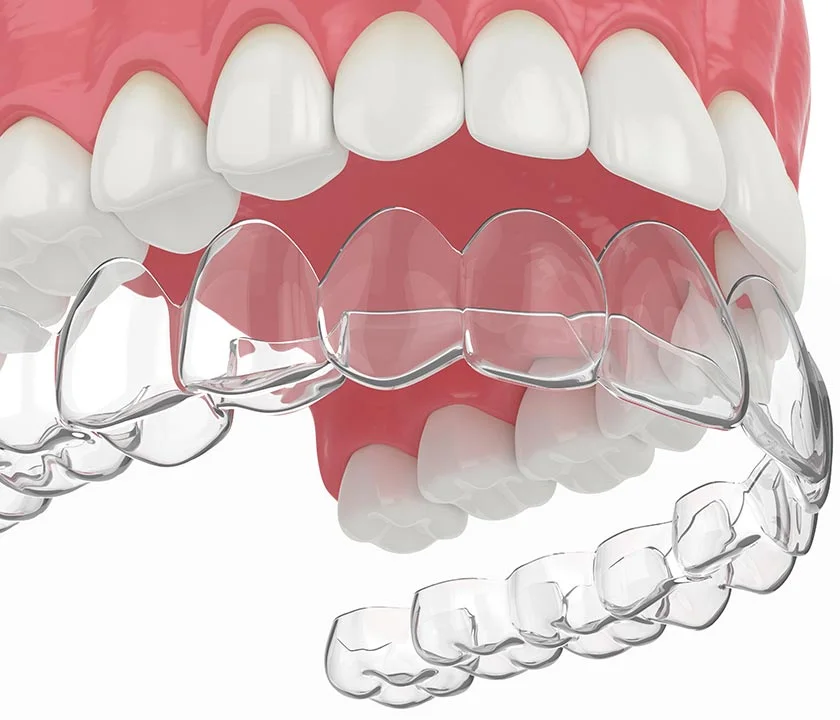 Clear aligner tray trim line shown against an upper arch model