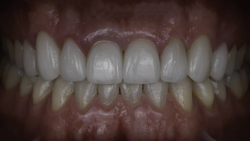 Smile makeover transforms shape, shade, and alignment, close-up view: after treatment