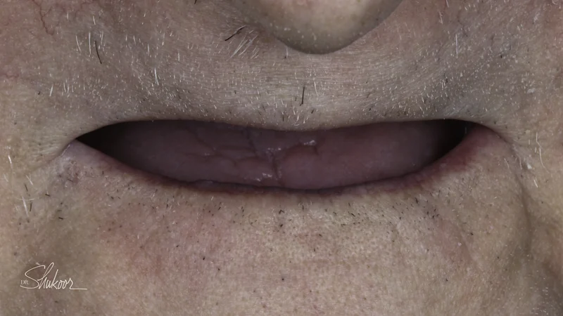 Full dentures restore a complete smile and comfortable bite, close-up view: before treatment