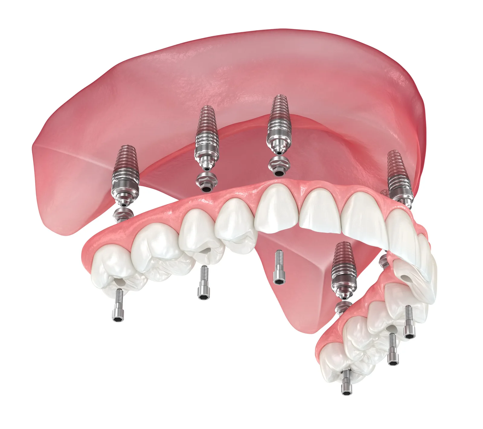 Full-arch implant prosthesis and implants shown in an exploded illustration
