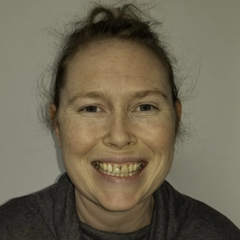 Stained, Chipped Teeth Transformed With Porcelain Veneers, close-up view: before treatment