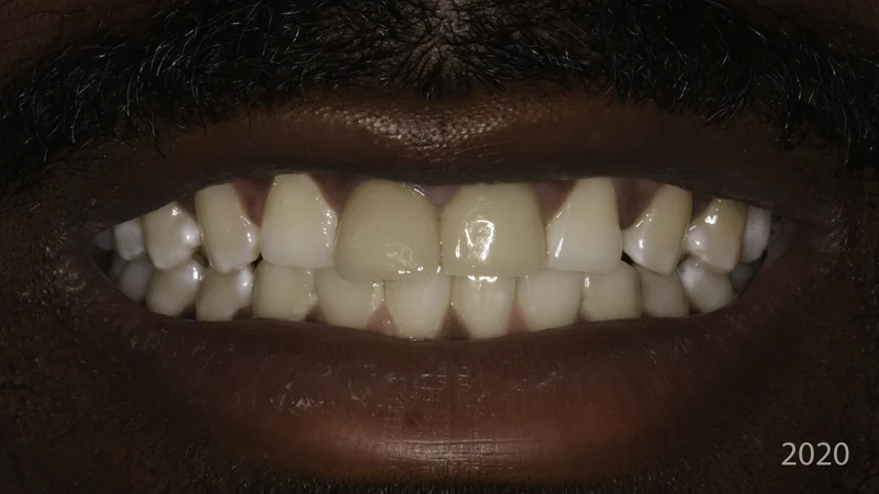 Worn, discolored front teeth restored with implant crowns, smile view: before treatment