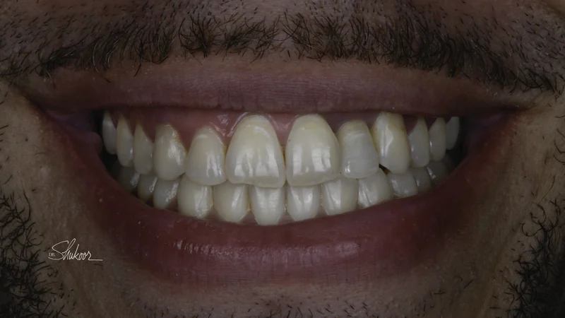 Crowded arch expanded and leveled with clear aligners, smile view: after treatment