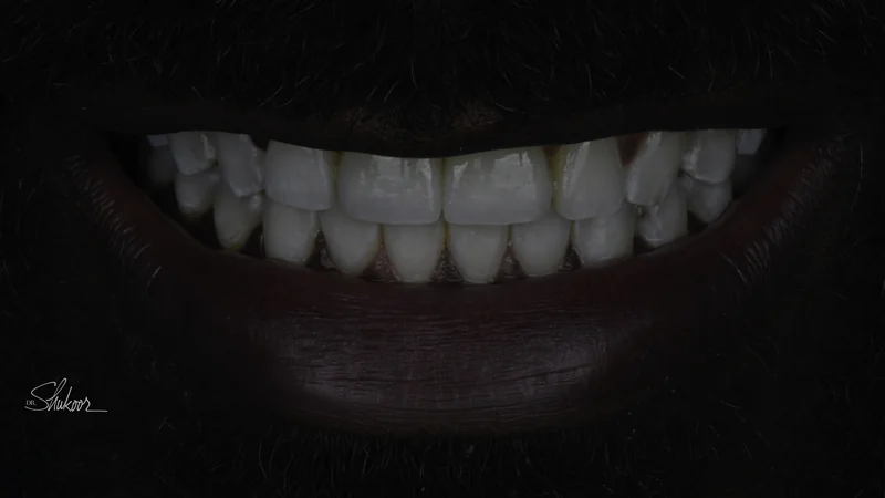 Worn, discolored front teeth restored with implant crowns, smile view: after treatment