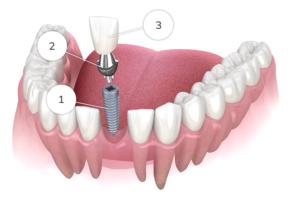 Illustration of a single dental implant, abutment and crown in the lower arch